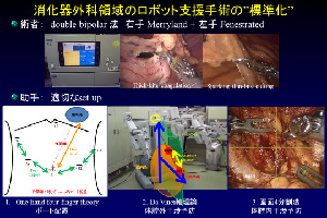 参考画像⑧　消化器外科領域のロボット支援手術の”標準化”